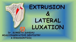 Extrusion and lateral luxation of teeth  Management Luxation injuries [upl. by Enitsrik]