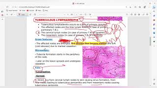 Non neoplastic lymhoma [upl. by Nereil]