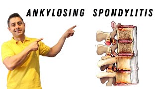 Ankylosing Spondylitis core exercises [upl. by Llezo]