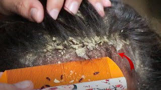 Removed Hundred of Lice From Head and Dry Scalp Huge Dandruff of Flakes Removal With Comb  1765 [upl. by Noillimaxam448]