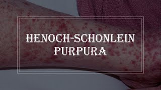 HenochSchonlein Purpura  purple rash on skin vasculitis [upl. by Asyl843]