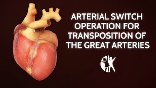 Arterial Switch Operation for Transposition of the Great Arteries  Cincinnati Childrens [upl. by Aneleh]