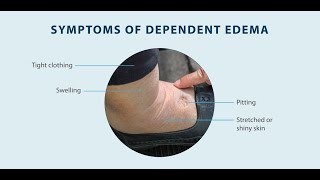 Dependent Oedema and Ascites as symptoms of cardiovascular diseases [upl. by Olenolin673]