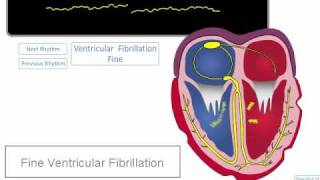 ECG Rhythm Review Coarse and Fine Ventricular Fibrillation [upl. by Hairam]