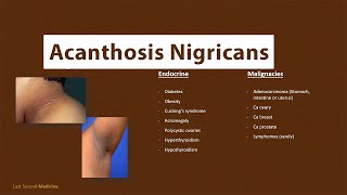 Acanthosis Nigricans  What is Acanthosis Nigricans amp What are its CAUSES [upl. by Freed]