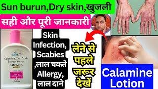 calamine lotion uses  calamine lotion  calamine lotion ip  calamine lotion malayalam  calamine [upl. by Darby]