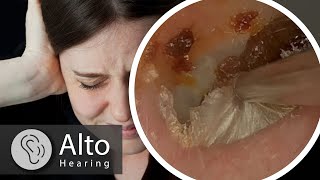 Ear Wax Removal CURES Tinnitus [upl. by Butler]