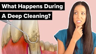 What Happens During a Deep Cleaning Procedure Scaling and Root Planing [upl. by Xineohp]