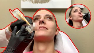 BOTOX LIP FLIP  WHY I COULDNT GET FILLERS [upl. by Sieber]