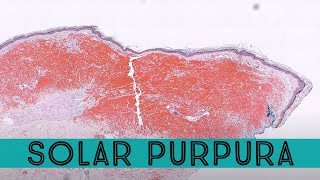 Solar purpura purple bruise like areas on elderly sun damaged skin pathology dermpath dermatology [upl. by Reni774]