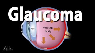 Development of Glaucoma Animation Open Angle vs Angle Closure Glaucoma [upl. by Itsim396]