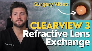 Refractive Lens Exchange RLE Surgery with the Clearview 3 Lens [upl. by Bonney426]