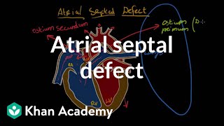 Atrial septal defect  Circulatory System and Disease  NCLEXRN  Khan Academy [upl. by Akym]