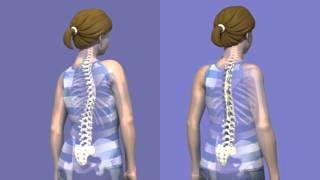 What is Scoliosis surgery [upl. by Petrie]