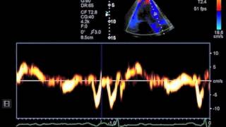 Hypertensive Heart Disease [upl. by Gusba]