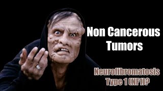 Noncancerous Tumors  What You Need to Know About Neurofibromatosis Type 1 NF1 [upl. by Occer]