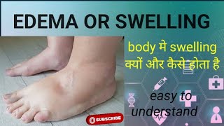 Edema or Swelling Edema kya hota hai Cause of Edema Pathophysiology of edema [upl. by Jowett]