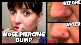 How To Get Rid Of A Nose Piercing Bump FAST  Keloid 📍 How To With Kristin [upl. by Ardyce]