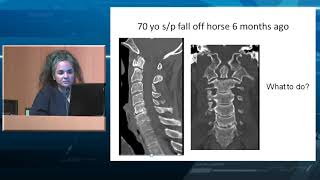 Management of Odontoid Fractures [upl. by Atnes244]