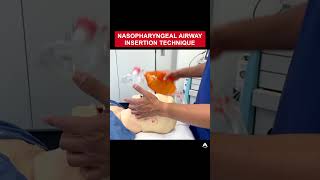 Nasopharyngeal Airway Insertion Technique  anesthesia bagmaskventilation airway [upl. by Anertal693]