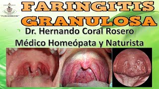 FARINGITIS GRANULOSA  INFLAMACIÓN DE LA FARINGE CON PERI ADENITIS COLORACIÓN ROJIZA [upl. by Aillicirp967]