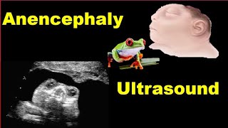 Anencephaly Ultrasound [upl. by Asiulairam]