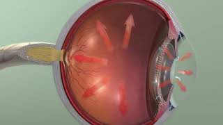 Animation Glaucoma [upl. by Jaddan]