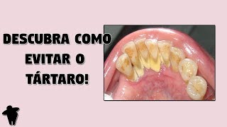 Como Tirar Tártaro dos Dentes em Casa  Descubra Como Evitar o Tártaro e Se Livrar Deste Problema [upl. by Harraf]