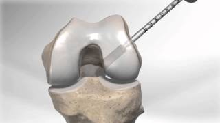 All Inside® ACL Reconstruction with GraftLink™ [upl. by Ahtekal]