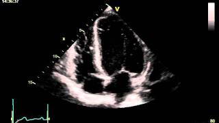 HYPERTENSIVE CARDIOMYOPATHY [upl. by Filemon995]