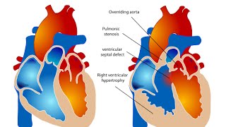 Tetralogy of Fallot [upl. by Ahseikram]