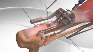 Achilles Tendon Rupture Repair with Arthrex® PARS System [upl. by Aidni]