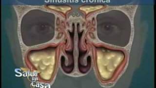 Cirugía de Sinusitis Relación con septo nasal y cornetes [upl. by Llenoil519]