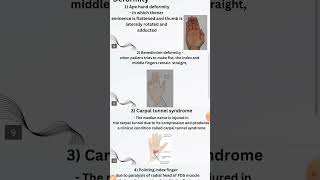 Median nerve palsy  IntroductionAnatomy CausesClinical Features DeformitySpecial testExercise [upl. by Arrek]