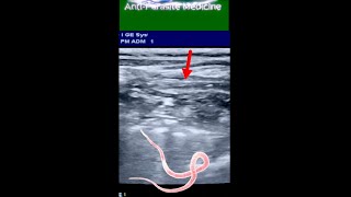 Long Ascaris Worm  in Small Intestine of 8 yrs Old Boy ultrasound [upl. by Libenson]