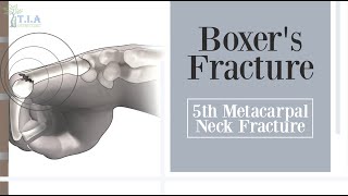 5th metacarpal neck fracture  Boxers Fracture [upl. by Yrannav]