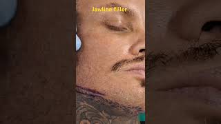 Jawline filler in Mumbai by Dr Vaibhav Shah jawlinefiller [upl. by Nytsuj559]