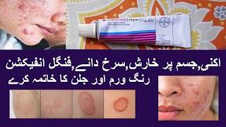 Travocort Cream Best Cream For Skin Problems Men amp Women [upl. by Aiem]