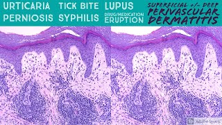 Urticaria Tick Bite Syphilis Lupus Perniosis etc Perivascular Dermatitis Pattern Dermpath [upl. by Woodson383]