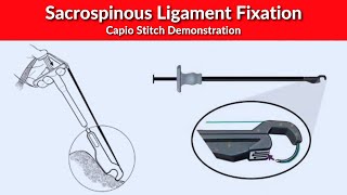 Sacrospinous Ligament Fixation  Capio Stitch Demonstration  Dr Kunal Rathod [upl. by Radford394]