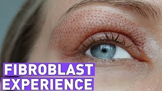 FIBROBLAST treatment experiencebefore and after 7 days [upl. by Rennie]