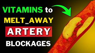 Remove Artery Plaque Naturally 6 Powerful Vitamins [upl. by Patrich]