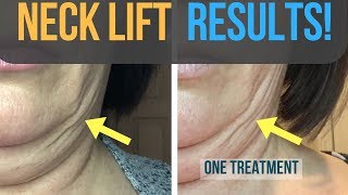 Results From My Fibroblast Plasma Neck Lift [upl. by Eiuol]