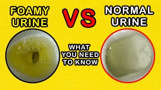 Foamy Urine vs Normal Urine What is the difference and causes [upl. by Gladdie961]