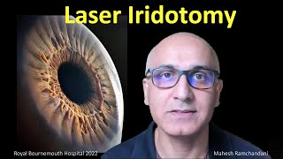 Laser Iridotomy the works Mahesh Ramchandani explores all about laser for angle closure glaucoma [upl. by Lekym353]