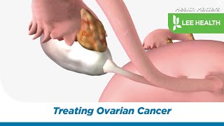 Treating Ovarian Cancer [upl. by Eveneg]