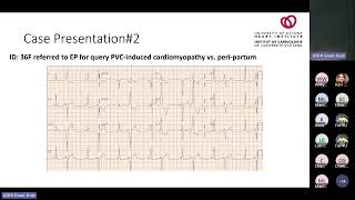 Frequent Ventricular Ectopy Defining Outcomes When and How to Treat with Michael Thibert MD [upl. by Oynotna926]