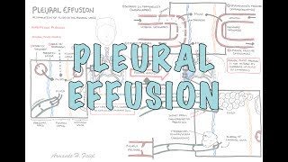 Pleural Effusion DETAILED  pathophysiology signs and symptoms treatment [upl. by Yllime]