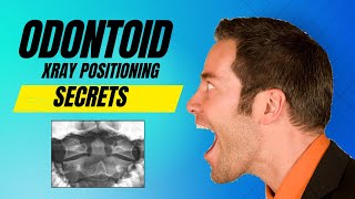 Secret To Odontoid Xray Positioning [upl. by Monjo856]