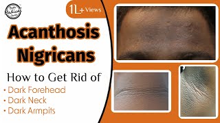 Acanthosis Nigricans How to Get Rid of Dark Neck amp Armpits  Dr Nivedita Dadu [upl. by Ynohta369]